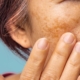 Le macchie sulla pelle del volto sono il risultato di un mal funzionamento dei melanociti. Scopri come rimuovere le macchie solari